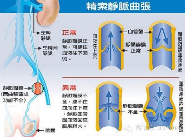 關(guān)于2021年征兵精索靜脈曲張標(biāo)準(zhǔn)的探討，2021年征兵精索靜脈曲張標(biāo)準(zhǔn)深度解析